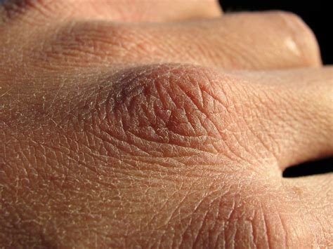 Dry Hands .